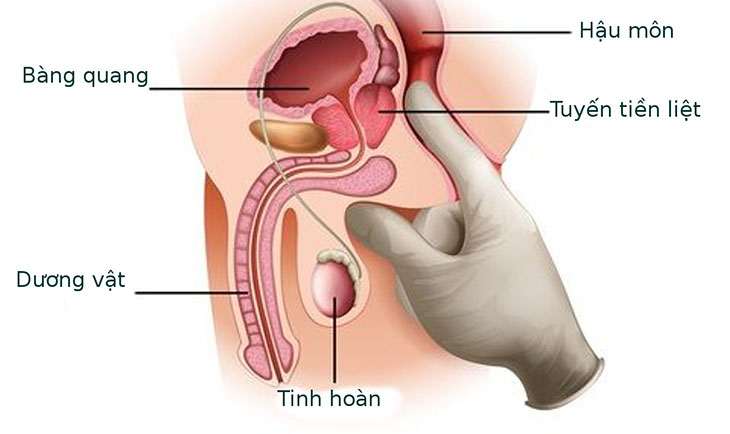 Bệnh lý ở niệu đạo - tuyến tiền liệt cũng có thể gây tiểu máu