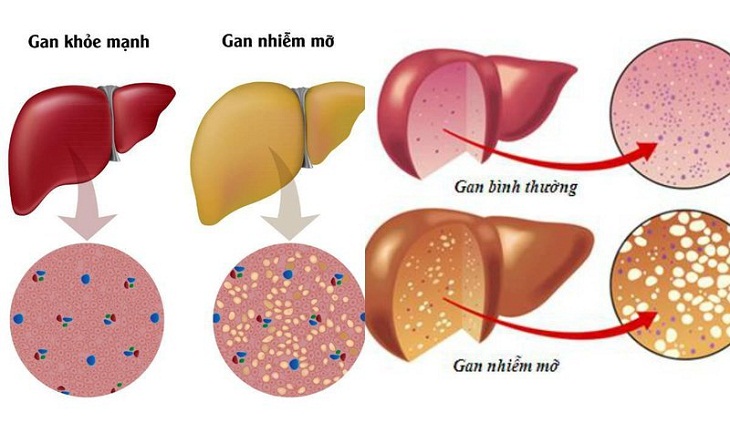 Có rất nhiều người có nguy cơ bị mắc bệnh gan nhiễm mỡ