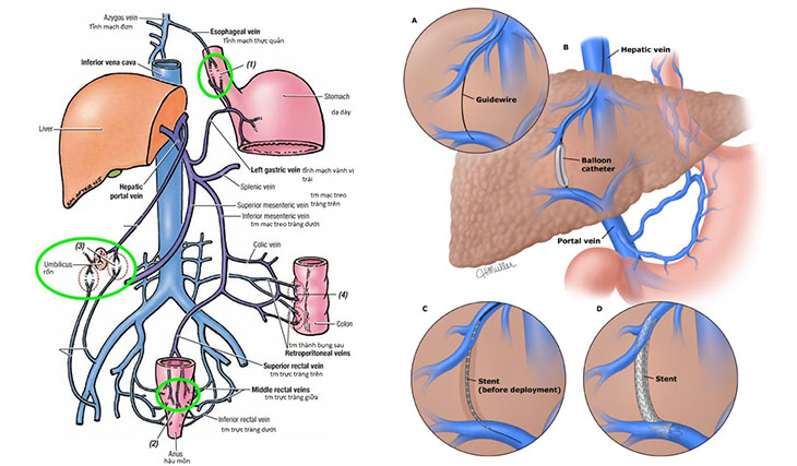 Cầu nối bên – bên hệ thống tĩnh mạch cửa với tĩnh mạch chủ