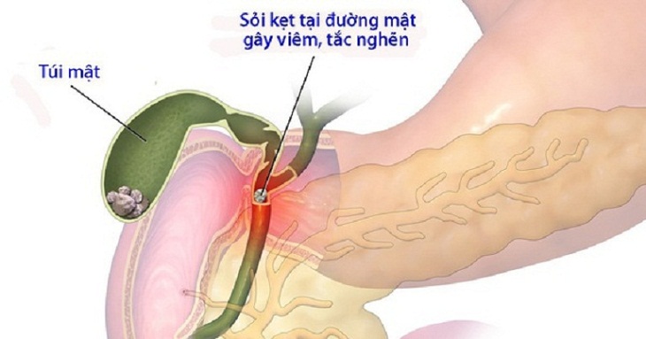 Bệnh gây ra nhiều biến chứng nguy hiểm, gây viêm, tắc nghẽn ở đường mật