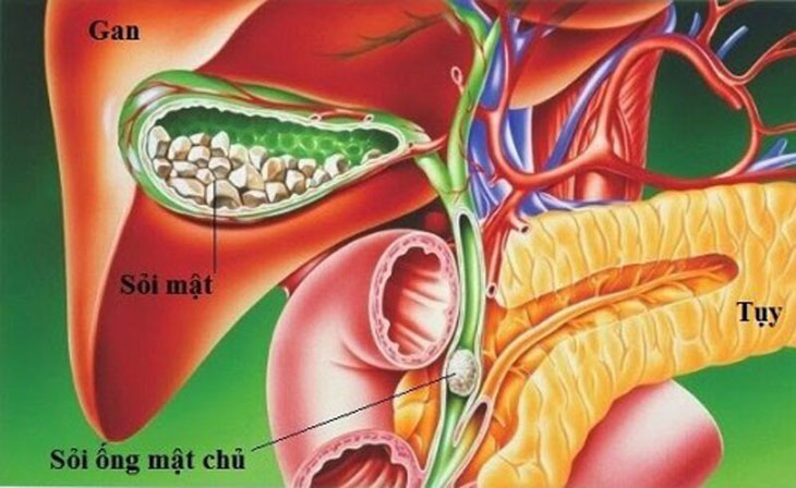 Hình ảnh mô phỏng sỏi ống mật chủ bệnh học