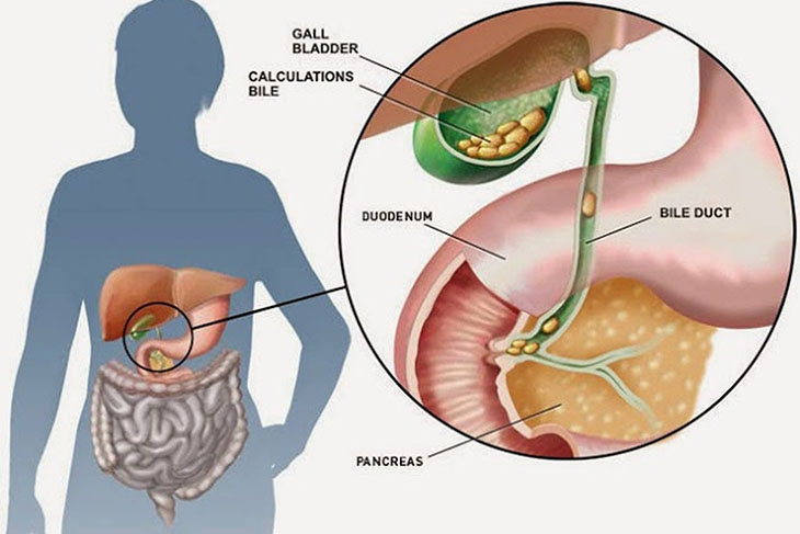 Giun chui ống mật và mang theo trứng hoặc xác trứng hình thành nên sỏi