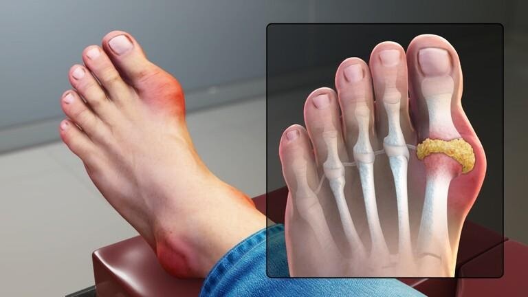 Người bệnh Gout cần tuân thủ liều lượng và liệu trình