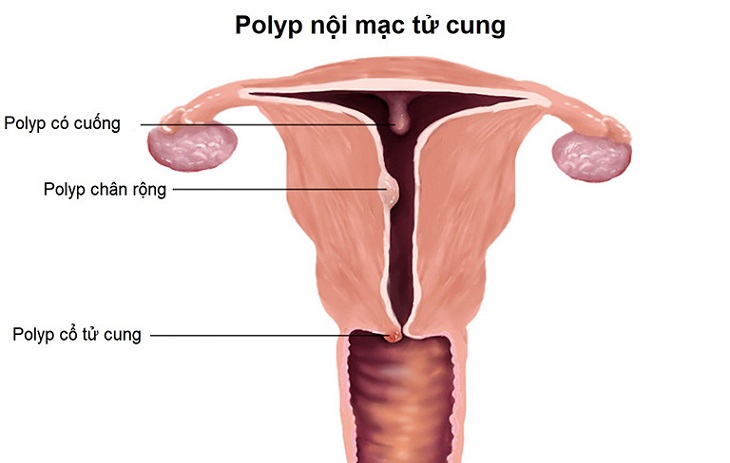 Tuổi mãn kinh bị ra máu do Polyp nội mạc tử cung