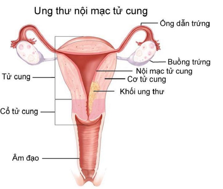 Ung thư nội mạc tử cung hay ung thư cổ tử cung cũng là một trong những nguyên nhân khiến chị em ra máu bất thường