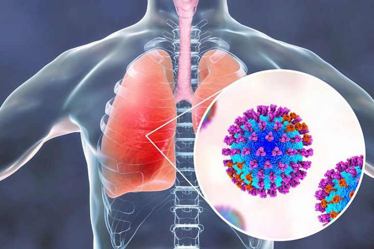 Tác nhân gây viêm phổi có thể do vi khuẩn hoặc virus gây nên