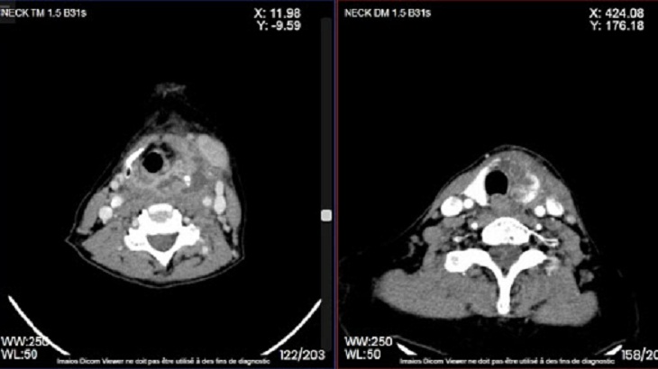 Chụp X-quang và chụp CT sẽ giúp phát hiện các tổn thương ở trong vùng cổ