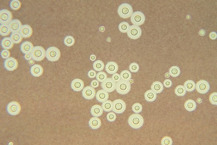 Bệnh viêm màng não do nấm Cryptococcus neoformans