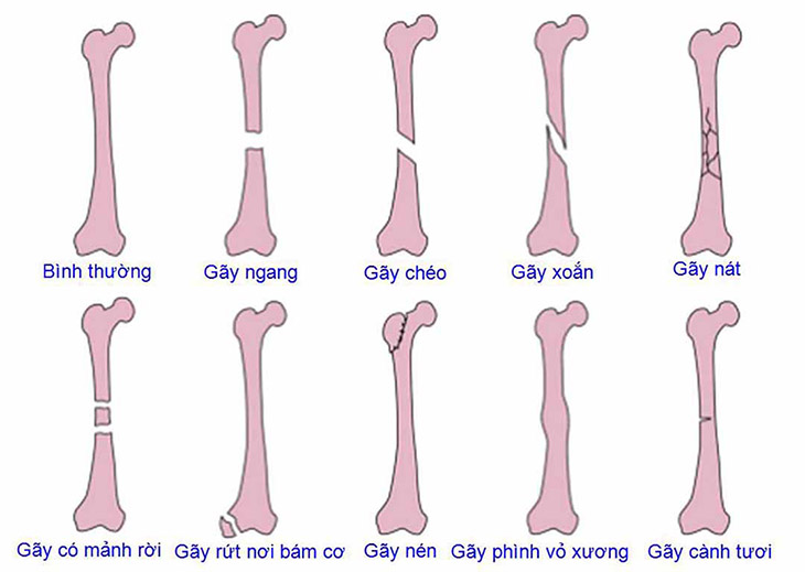 Triệu chứng rõ nhất của bệnh là bị gãy xương