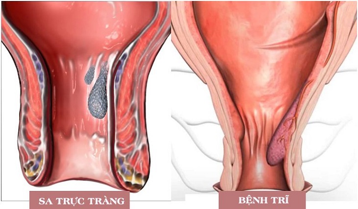 Bệnh trĩ thường bị nhầm với bệnh sa trực tràng