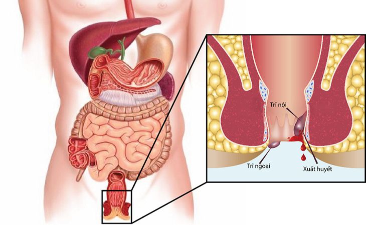 Chẩn đoán bệnh trĩ là việc làm cần thiết khi có những biểu hiện bất thường