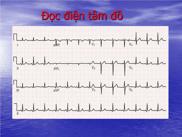 Sóng T cho biết sự tái cực tâm thất và thường dương hoặc âm cùng chiều với QRS