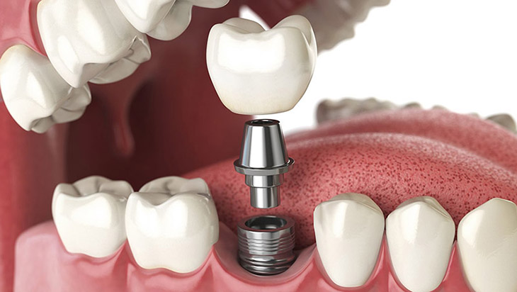 Cấy ghép implant tránh được tình trạng tiêu xương hàm