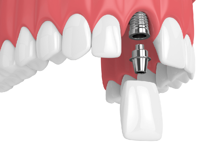 Phương pháp cấy ghép implant