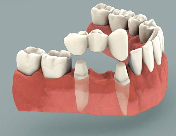 Cầu răng sứ có nhiều ưu điểm hơn so với hàm giả tháo lắp