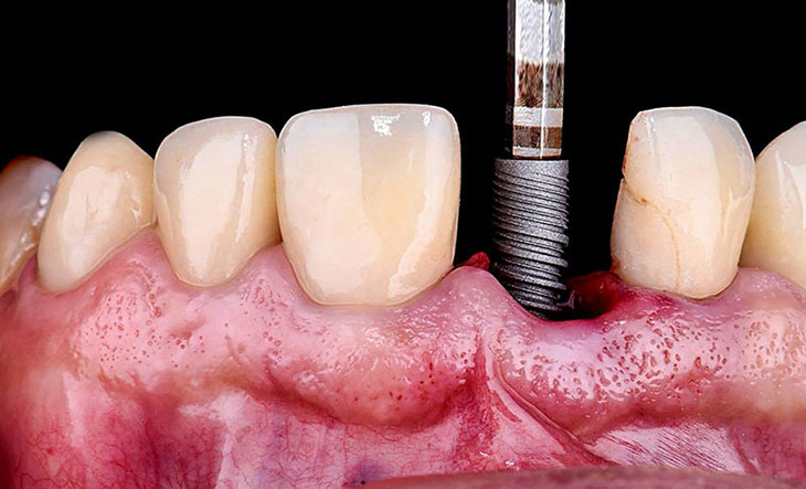 Tình trạng trồng răng implant bị đào thải khá phổ biến