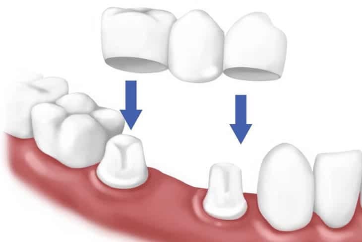 Trồng răng sứ là kỹ thuật nha khoa giúp phục hồi phần răng bị hư tổn