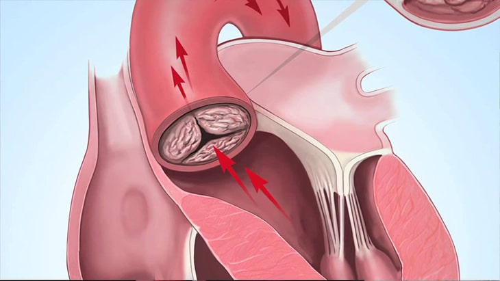 Cần quan sát đóng vôi động mạch trên phim X-Quang