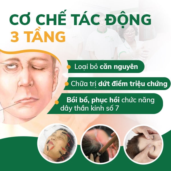 Cơ chế điều trị 3 tầng trị liệu và phục hồi hoàn toàn dây thần kinh số 7