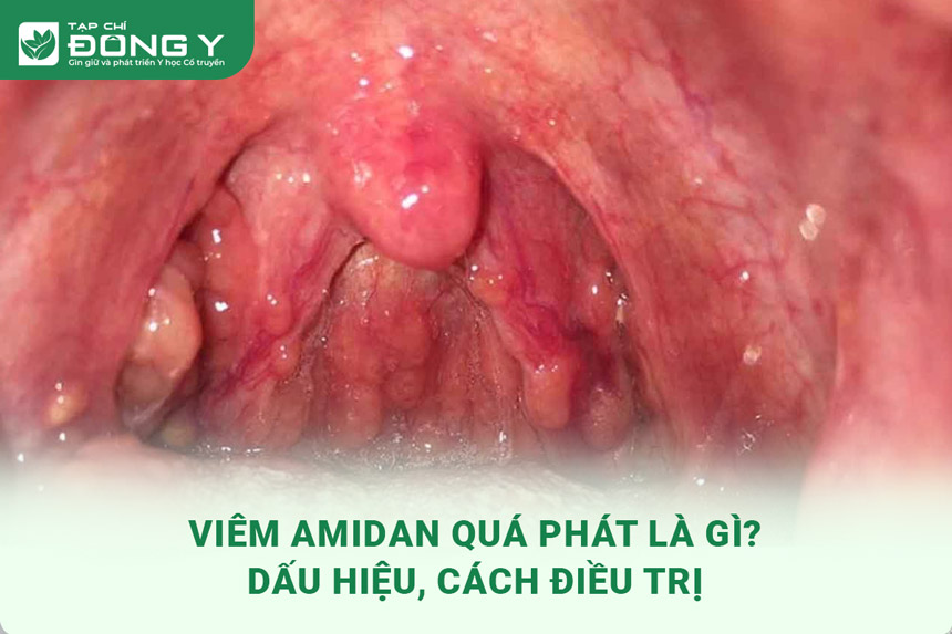 viem amidan qua phat