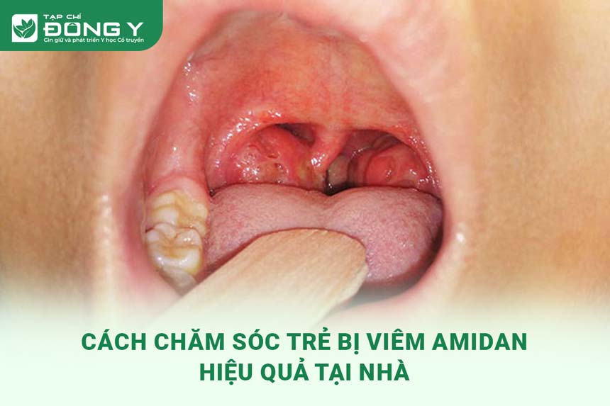 cach-cham-soc-tre-bi-viem-amidan