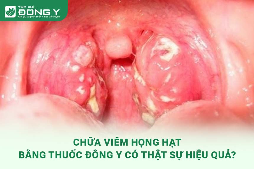 chua-viem-hong-hat-bang-thuoc-dong-y