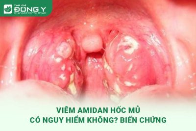 viem-amidan-hoc-mu-co-nguy-hiem-khong