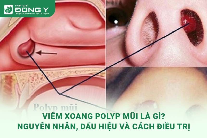 viem-xoang-polyp-mui