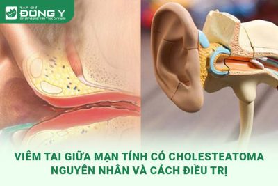 viem-tai-giua-man-tinh-co-cholesteatoma