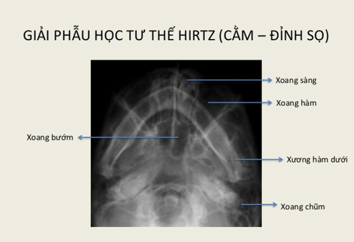 viem-xoang-buom