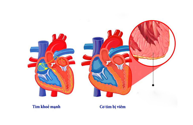 Biến chứng nghiêm trọng nhất của bạch hầu, gây tổn thương cơ tim, suy tim, rối loạn nhịp tim, thậm chí tử vong