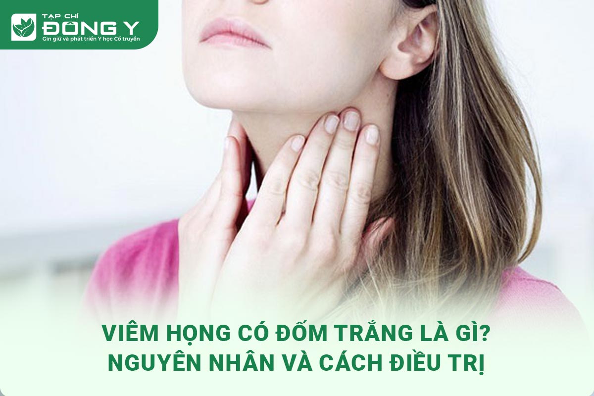 viêm họng có đốm trắng