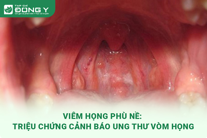 3. Các biện pháp hỗ trợ điều trị viêm vòm họng tại nhà