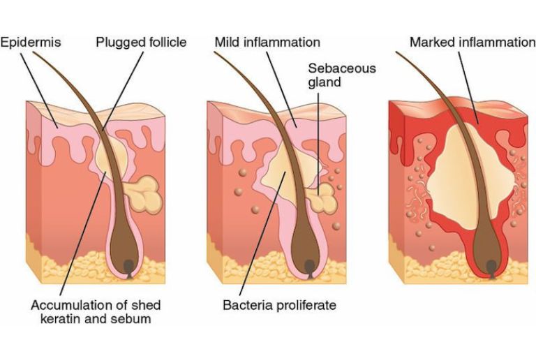 Cấu trúc mụn viêm và mụn không viêm