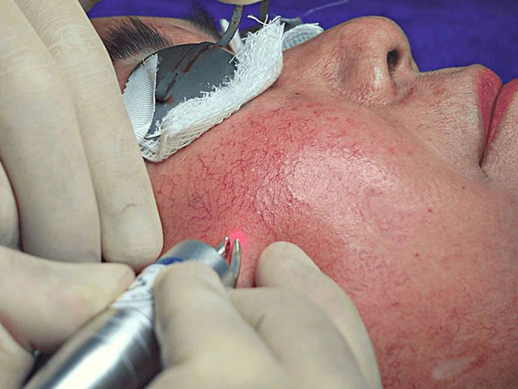 Công nghệ Laser mạch máu khắc phục tình trạng da nhiễm corticoid