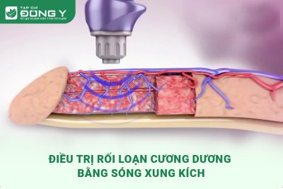 Điều trị rối loạn cương dương bằng sóng xung kích