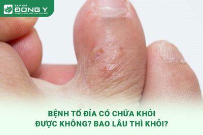 benh-to-dia-co-chua-khoi-duoc-khong