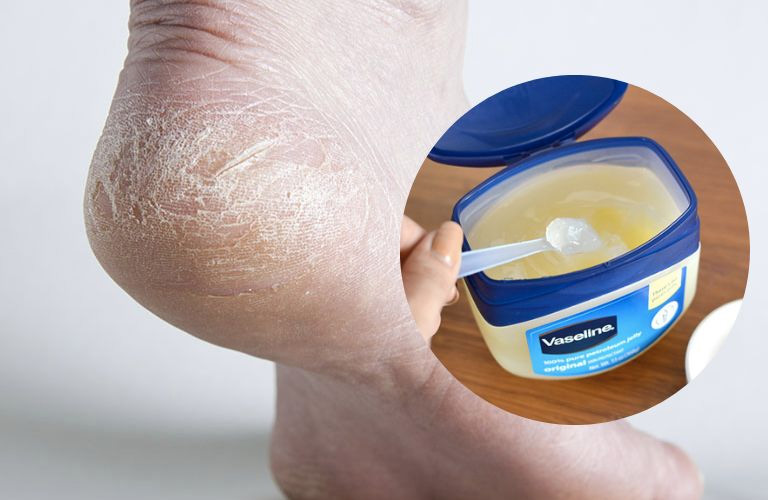 Trị nứt gót chân bằng Vaseline