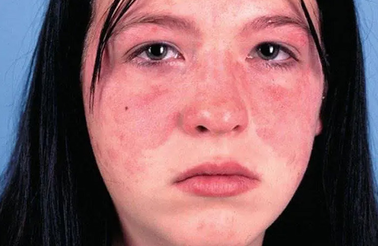 Lupus hệ thống có thể là nguyên nhân khiến da bị khô nhăn