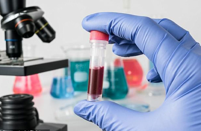 Xét nghiệm máu được chỉ định nhằm loại trừ các bệnh lý toàn thân