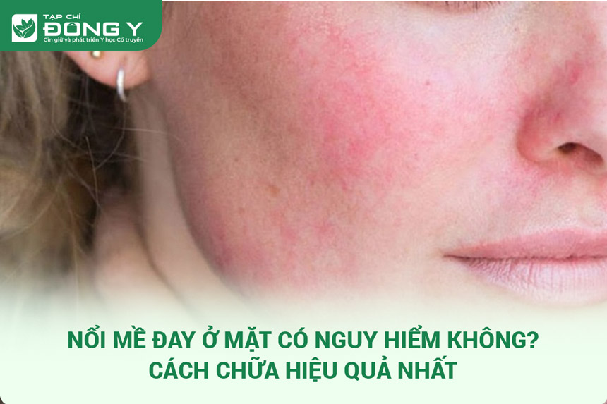 nổi mề đay ở mặt