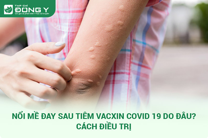 Nổi Mề Đay Sau Tiêm Vaccine Covid 19