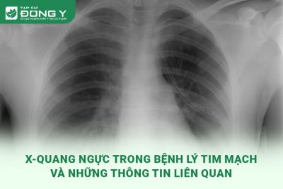 x-quang-nguc-trong-benh-ly-tim-mach