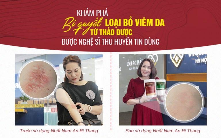 Hình ảnh làn da của nghệ sĩ Thu Huyền trước và sau điều trị