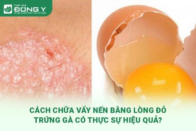 cach-chua-vay-nen-bang-long-do-trung-ga