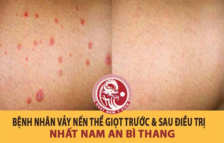 Một vùng da chân bệnh nhân Đinh Huyền trước và sau điều trị vảy nến thể giọt bằng Nhất Nam An Bì Thang