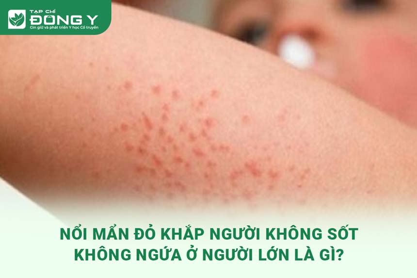 Nổi Mụn Khắp Người Không Ngứa: Nguyên Nhân, Triệu Chứng và Cách Điều Trị Hiệu Quả