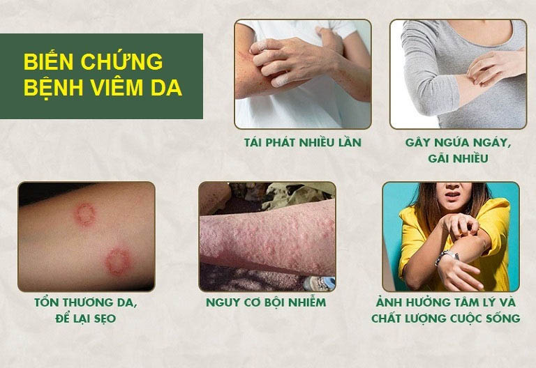 Viêm da nếu điều trị sai cách có thể dẫn tới nhiều biến chứng nghiêm trọng