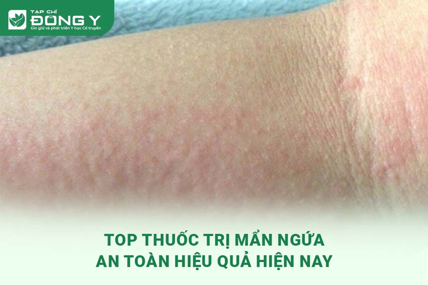 thuoc-tri-man-ngua