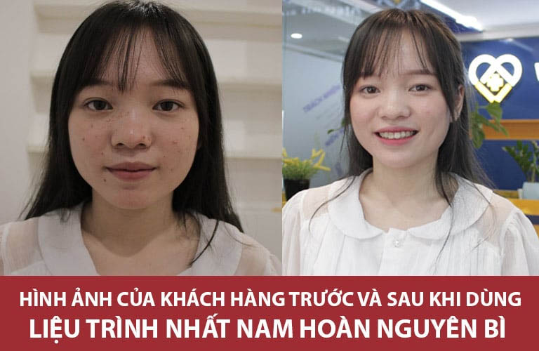 Làn da của Linh đã cải thiện rất tốt sau 3 tháng sử dụng Nhất Nam Hoàn Nguyên Bì